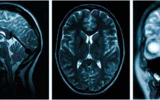 Если часто болит голова какое мрт лучше сделать