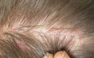 Красные пятна на голове и болят