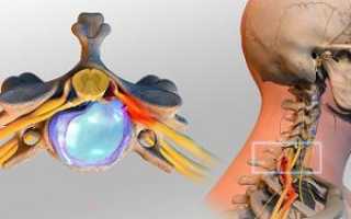 При позвоночной грыже болит голова