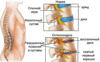 При защемление в спине болит нога