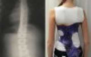 У подростка болит спина сколиоз