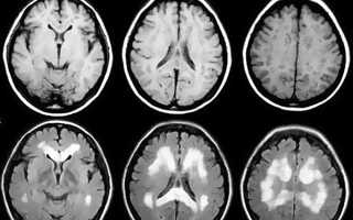 Болит голова при кашле отдает в затылок