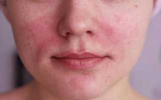 Резко краснеет лицо и болит голова