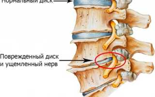 Болит спина в области поясницы когда долго лежишь
