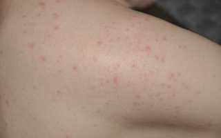 Высыпания на спине болит