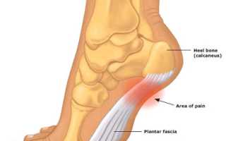 Если болит пятка от спины