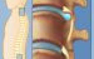 Где болит спина при грыже