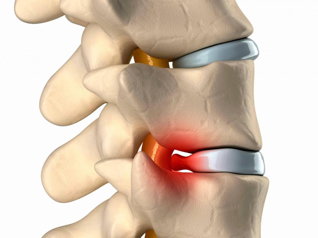грыжа поясничного отдела позвоночника симптомы