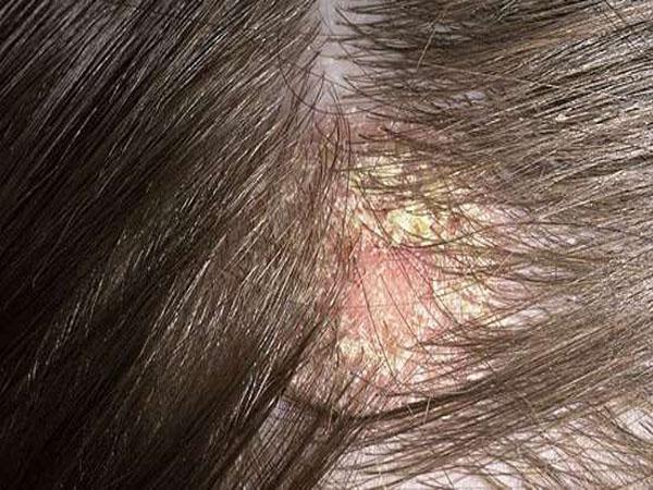 красные пятна на голове и болят