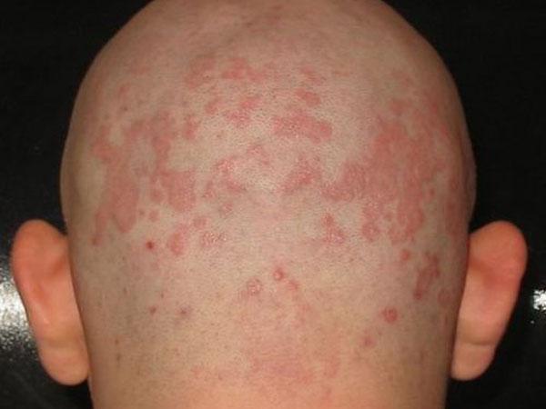 красные пятна на голове и болят