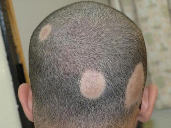 красные пятна на голове и болят