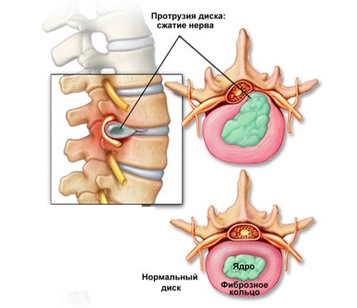 Протрузия позвоночника