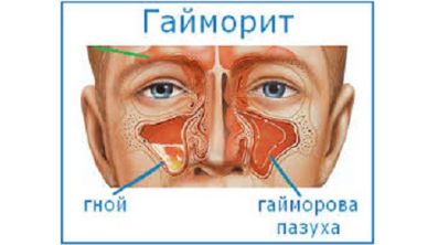 болит вся спина и температура 37