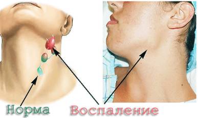 болит вся спина и температура 37