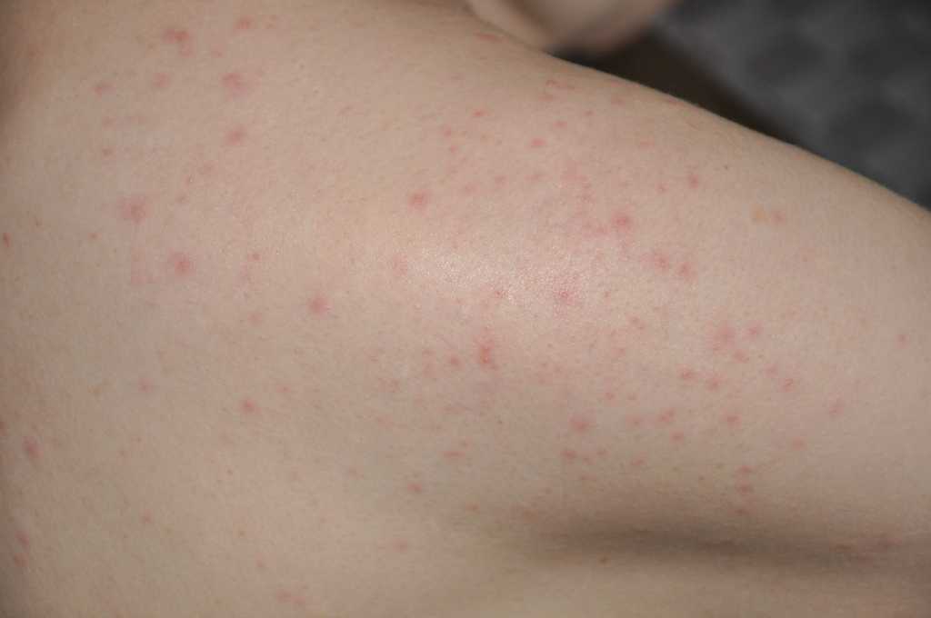 Сыпь на спине