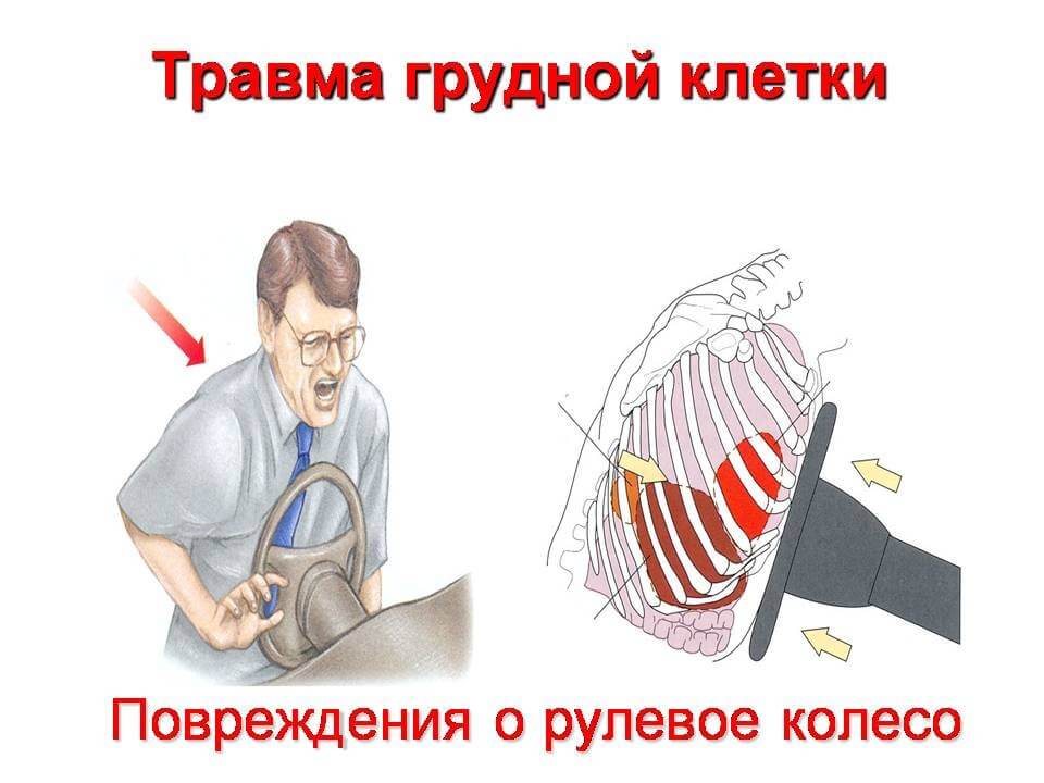 Травма грудной клетки при ДТП