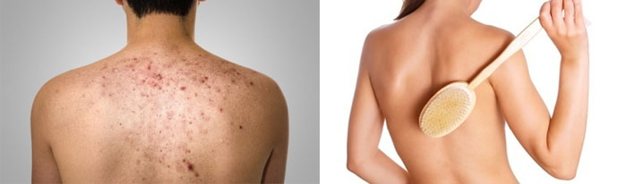 Высыпания в области спины