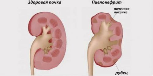 Пиелонефрит