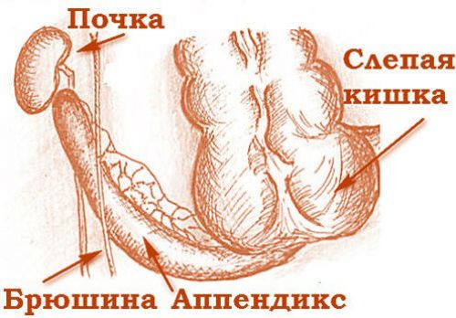 Аппендицит