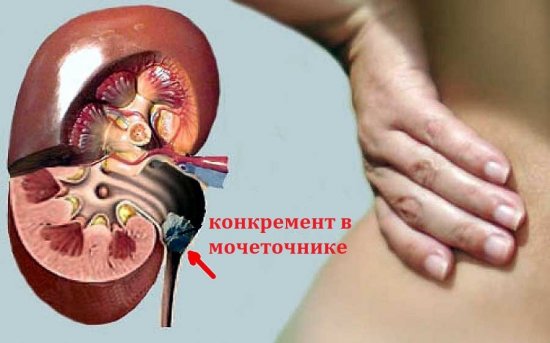 Камень в почке