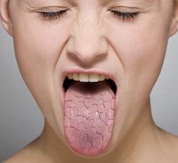Сухость во рту Что это значит