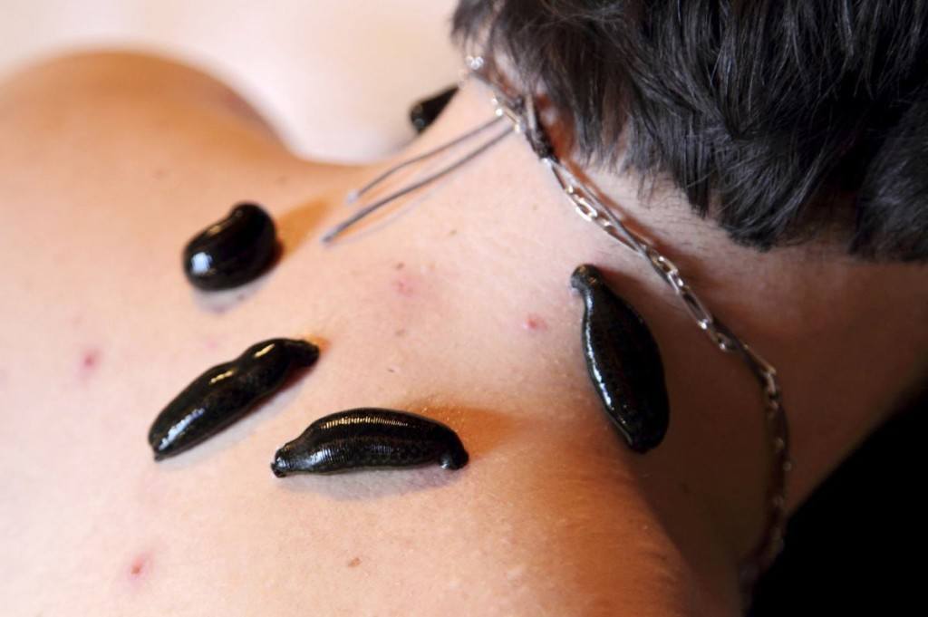 Гирудотерапия шейного отдела