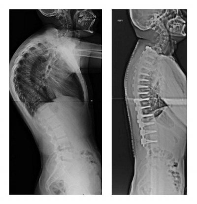 Результат хирургического лечения горба на спине