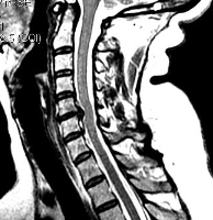 грыжа диска в шейном отделе-сагиттальная МРТ