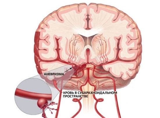 Кровоизлияние в мозг Кровоизлияние в мозг