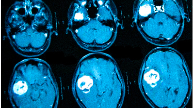 Онкологи считают, что при нарастающих головных болях с прочими необъяснимыми симптомами (обмороками, ухудшением памяти, выпадением полей зрения, давлением на глазные яблоки и др.) в первую очередь следует исключить опухолевую патологию