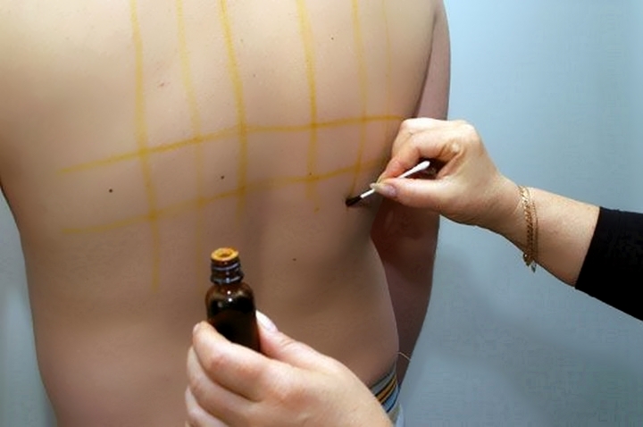 Нанесение йодной сетки