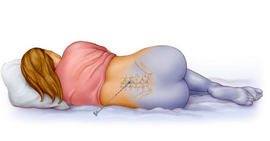 Онемение после анестезии