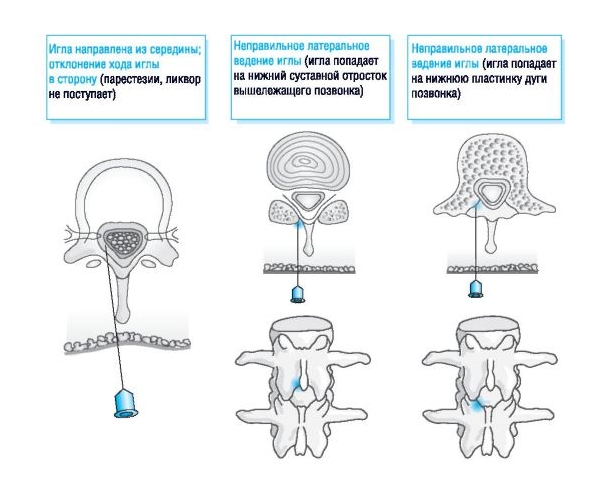 Ошибки при введении эпидуральной анестезии