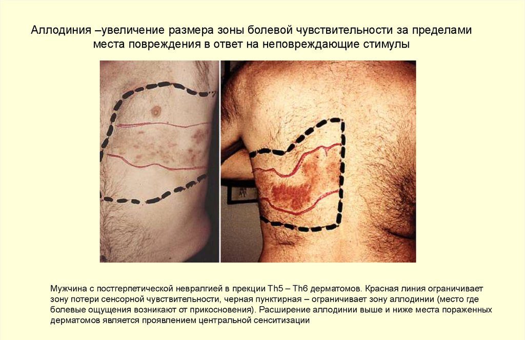 Определение аллодинии
