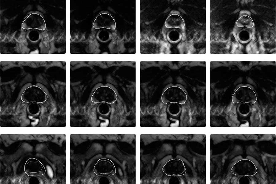 диагноз дгпж в урологии диагноз дгпж в урологии