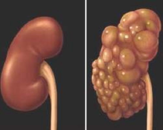 Множественные кисты почек Множественные кисты почек