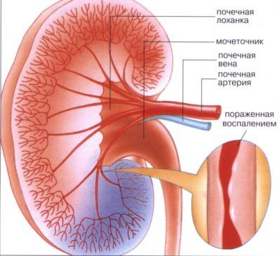 Воспаленные канальцы
